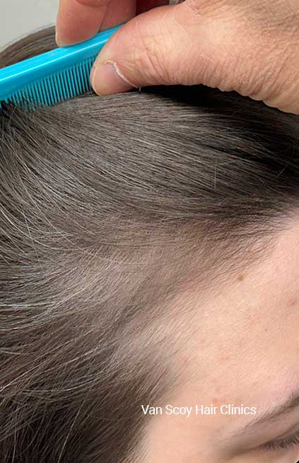 DeRive hair restoration Van Scoy Hair Clinics Ohio