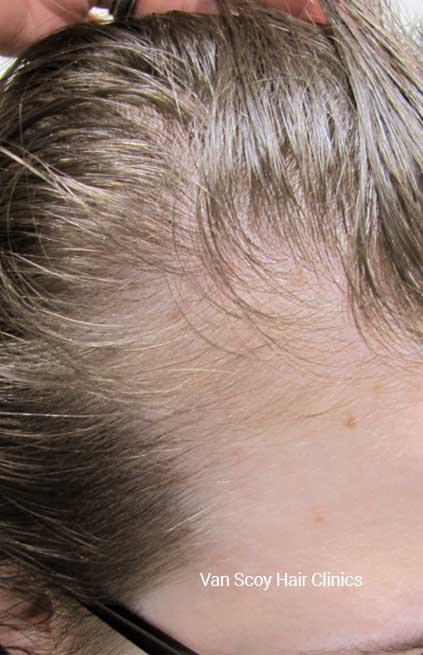 DeRive hair loss treatment Van Scoy Hair Clinics Cleveland Ohio