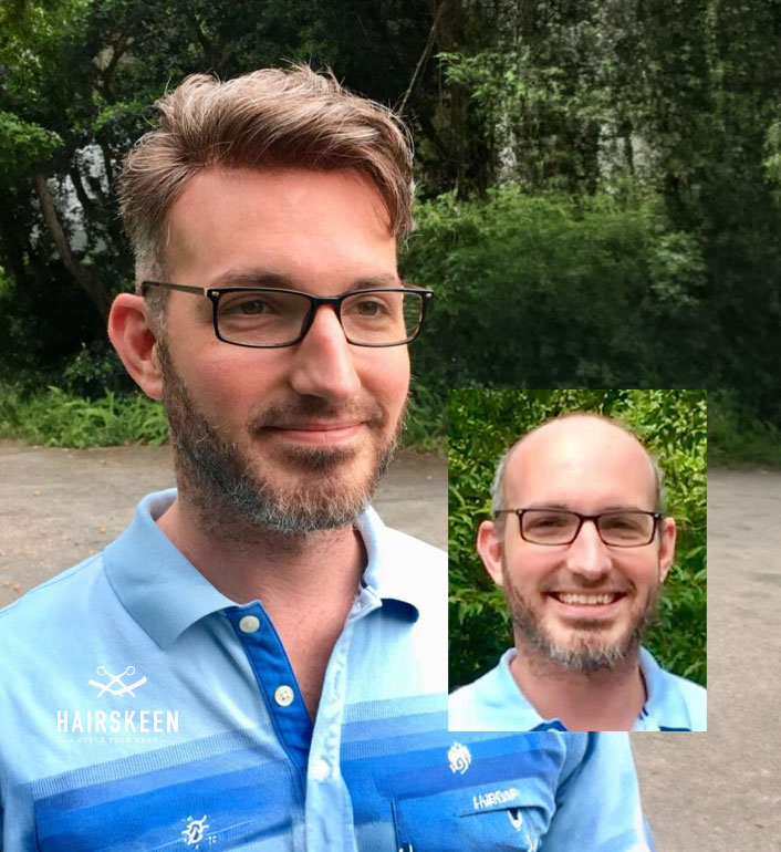 Hairskeen European Mens custom toupee van scoy clinics parma columbus ashland ohio