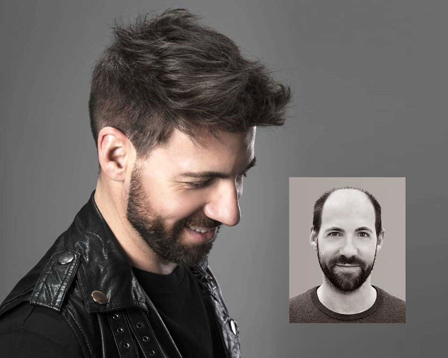 Hairskeen non-surgical hair replacement van scoy ohio