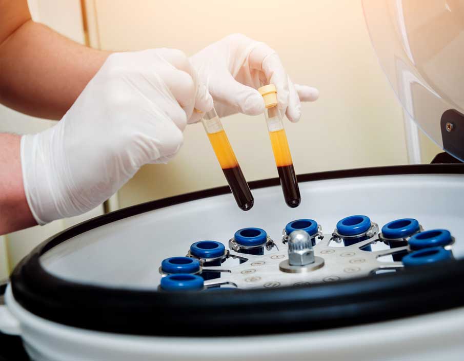 PRP Hair Regrowth Therapy Cleveland Columbus Ashland Ohio