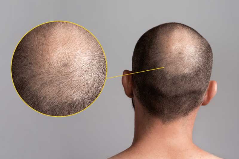 Types-of-Hair-Loss_Definitions,-Causes_How-to-Identify-Yours Types of Hair Loss: Definitions, Causes & How to Identify Yours