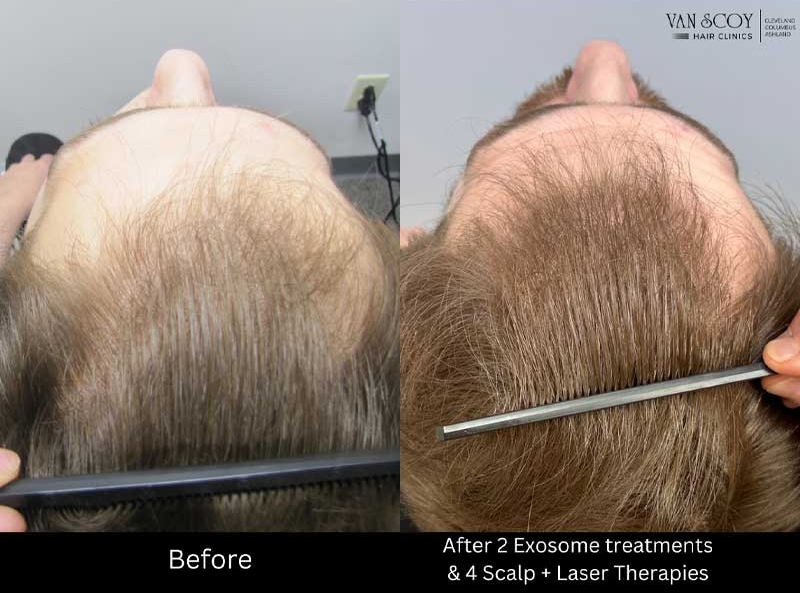 exosome-hair-loss-treatment-cleveland-columbus-ohio Exosome hair loss treatment cleveland columbus ohio