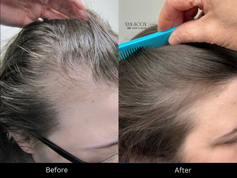 exosome-hair-regrowth-therapy-cleveland-columbus-ohio Exosome hair regrowth clinic Cleveland Columbus Ashland Ohio