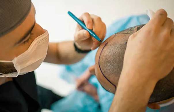 hair transplant timeline vanscoy hair clinics ohio