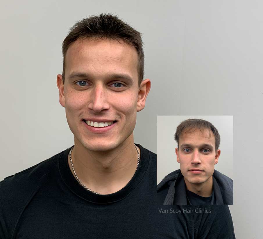 mens hair replacement specialists van scoy columbus cleveland ashland ohio