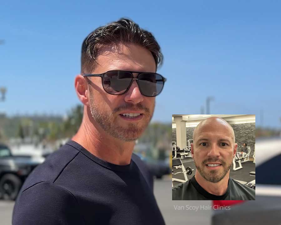 non-surgical men's hair replacement cleveland columbus ashland ohio