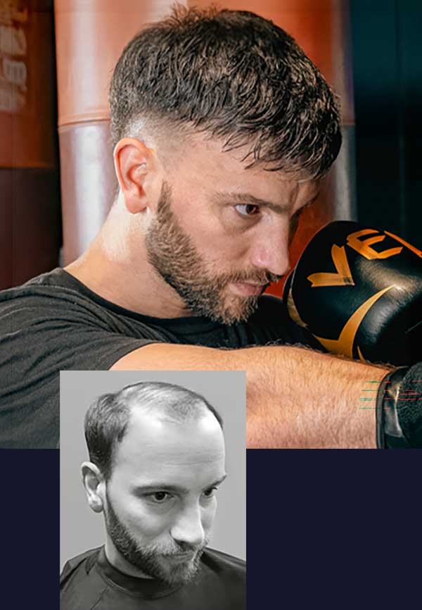 undetectable custom mens hair replacement ohio