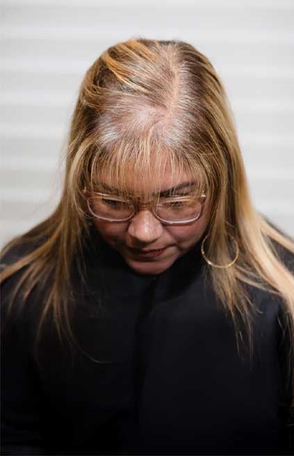 womens-hair-replacement-before-photo-van-scoy-hair-clinics Women's Non-Surgical Hair Replacement Ohio Cleveland Columbus Ashland