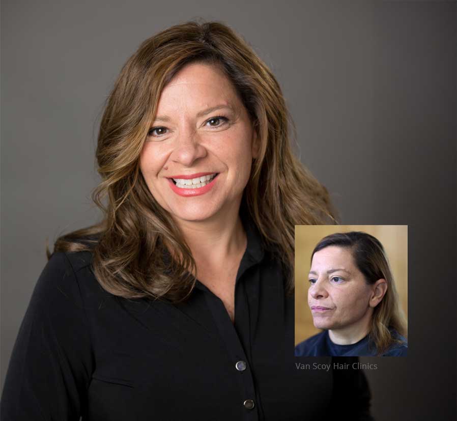 women’s-non-surgical-hair-replacement-van-scoy-hair-clinics-ohio Women's Non-Surgical Hair Replacement Ohio van scoy hair clinics